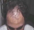 calvitie greffe de cheveux